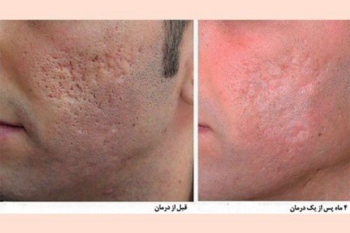 قبل و بعد از لیزر پوست