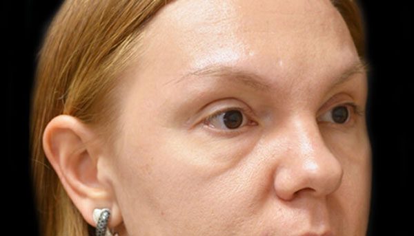 عوارض تزریق ژل زیر چشم